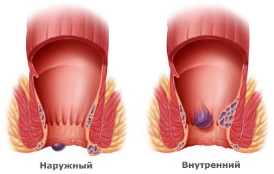 внутренний и наружный геморрой